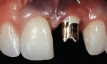 Figure 1  Initial placement of ceramic-metal augmented abutment after repeated osseous and connective-tissue grafts of the upper left central incisors. Clinical photograph from 10 years ago.