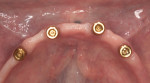 Figure 9 View of implant sites at 2-month recall.