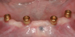 Figure 10 View of implant sites at 2-month recall.