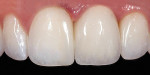 Figure 2  Placement of an all-ceramic crown showing resultant alteration in tooth form caused by loss of the papillae, ie, long restorative contact point between centrals. Clinical photograph from 10 years ago.