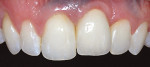 Figure 3  Patient presentation 10 years after the entail grafts and implant placement. The patient presented with a relative change in the position of tooth No. 9. This probably was caused by either a late growth spurt where the maxillary bone and te