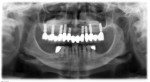 Figure 4 A combination of maxillary sinus grafting, the selective use of 9 mm implants and
additional implants were strategies used to provide a fixed metal ceramic prosthesis
opposing a metal ceramic implant supported prosthesis in the mandible. Additional
concerns included a clenching habit and possible bruxism.