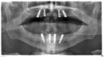 Figure 5 Avoiding grafting while
creating displacement of implant placement often requires the use of tilted implants.
This strategy, popularized as an all-on-four concept, can achieve distribution and meet
many of the challenges of dimension and density.