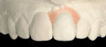 Figure 5  The diagnostic wax-up restoring the incisal and coronal harmony to tooth No. 9 and redeveloping the laboratory soft-tissue profiles in pink composite (wax also can be used) on the model's restorative gingival interface, ie, the mesial