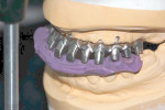 Figure 8 The development of the final prosthesis is congruent
with the pre-surgical planned position of the prosthetic teeth.