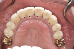 Figure 10 The esthetic
result was predictably achieved based on the initial diagnostic tooth arrangement.