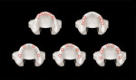 Figure 11 Distribution of implants in the edentulous maxilla. (Top left) Anterior implants
avoiding the sinuses was an original concept that presented a large distal cantilever and
afforded no opportunity for distribution. (Top right) Sinus grafting and use of posterior
implants provides a solution for dimension, but can lead to a large anterior cantilever;
proponents identify the absence of anterior implants as a possible esthetic advantage.
(Bottom left) Four implants with wide distribution can be achieved using tilted implants;
a full-arch prosthesis is required. (Bottom center) Six implants may be placed using sinus
grafting, tilted implants, or short implants to address the posterior region; a prosthesis
segmented at the midline is possible. (Bottom right) Eight implants may offer the advantage
of having short span, segmented prostheses that offer lower hurdle of managing
complications.