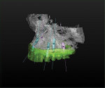 Figure 13 A high-quality image of the bone
and of the prosthesis must be visible in the 3D model for comprehensive planning. This
permits evaluation of multiple strategies and identification of implant position, abutment
dimension, and orientation prior to implant surgery. This shows the edentulous maxilla
and tooth arrangement viewed using a dual scan of the diagnostic denture.