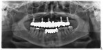 Figure 12 An emerging use of short implants, based on short term data, allows
implants to be placed in bone of restricted dimension. However, implants with moderately
rough surface topography, sufficient diameter and placement with optimal displacement
is required. Longer term data is needed to determine the extent this strategy may
play in management of the edentulous maxilla.