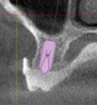 Figure 15 Cross-section revealing the proposed
placement of the implant and abutment dimension in the anterior region (note the
angled abutment resolving the screw access conflict with esthetic tooth display).