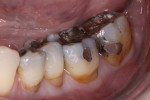 Figure 1 Buccal view of teeth No. 18 through No. 21 with recession at the gumline.