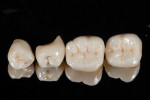 Figure 5 The completed monolithic
restorations after sintering and staining.