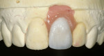 Figure 8  Pink composite was added to the wax-up, simulating the optimal form of the softtissue profiles and relocating the restorative gingival interface coronally.