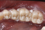 Figure 6 The crowns were traditionally cemented using a resin-modified glass ionomer cement
with a tack-cure option for easy cleanup.