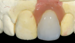 Figure 12  The completed composite ceramic crown surrounded by the simulated restorative gingival interface.
