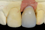 Figure 13  The ceramic crown with pink gingival simulation removed the deficiency of soft-tissue, resulting in an untoward esthetic 