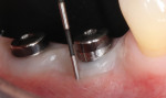 Figure 3. The peri-implant tissues are significantly more delicate than those around a natural tooth. All reasonable measures should be taken to protect the integrity of the seal around the implant and the abutment.
