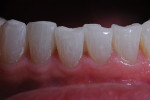 Figure 4. Mandibular teeth with sharp and irregular incisal edges.