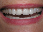 Figure 5. Incisal wear modified with composite prior to new crown fabrication.