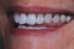 Figure 2. Provisional restorations with similar chipping.