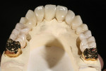 Figure 9. Final restorations in place on the model display good integration of e.max LiS2, Zenostar Zirconia, and gold. The zirconia restorations are internally colored and polished on the functional surfaces. They are layered only on the facial. This strategy of keeping layering ceramic out of functional areas as much as possible, greatly improving the long-term durability of the case.