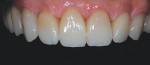 Figure 10. Clinical try-in of restorations.