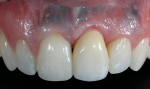 Figure 16  The two-piece abutment and crown in position. Note that the margin of the crownwas supragingivally positioned just apical to the level of the adjacent incisor and slightly apical to the level of the potential composite gingival level.