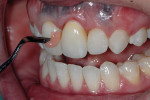 Figure 17  Pink composite was directly bonded intraorally to the abutment, with the crown in position to develop a perfect interface between the pink gingival composite, the crown, and the compromised site.