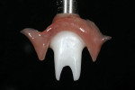 Figure 18  After removal from the mouth, the pink augmented abutment was finished chairside by removing the excess flash and sharp concavities and polishing the composite. (Finishing can also be performed in the dental laboratory.)