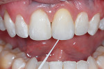 Figure 20  The restoration was designed to allow the patient to be able to remove plaque and debris accumulating at the soft tissue-restorative interface. Floss must pass readily through the contacts and over the flat or convex apical areas to be abl