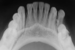 Figure 3 Preoperative occlusal radiograph showing fracture of the parasymphysis of the mandible (Case 1).