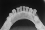 Figure 5 Postoperative occlusal radiograph showing healing of the fracture site (Case 1), 3 weeks after the preoperative radiograph.