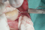 Figure 13 Photograph showing placement of splint with circummandibular wiring, used in cases of non-displaced fractures.
