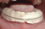 Figure 14 Photograph showing cementation of splint onto the arch.