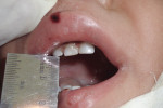 Figure 15 Preoperative photograph showing reduced mouth opening following symphysis fracture (Case 6).