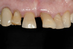 Figure 4 Preoperative view. Disrupted gingival architecture and tooth migration.