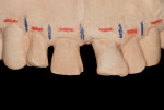 Figure 6 Pre-extraction study cast depicting planned altered gingival levels (red lines) and position of titanium rods (blue vertical lines).
