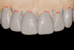 Figure 8 Diagnostic wax-up. Restored inter- and intra-dental proportions.