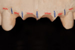 Figure 7 Modified study cast with simulated tooth extractions.
