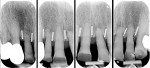Figure 11 Pre-extraction radiographic control showing inserted titanium bars.