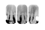 Figure 5 Preoperative radiographs. Localized severe horizontal bone loss can be observed.