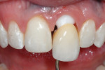 Figure 24  The crown was cemented in position over the abutment and restorative gingival profile.