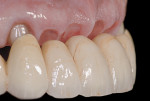 Figure 17 Intraoral try-in of metal-ceramic fixed partial denture.