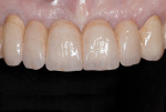 Figure 18 Luted fixed partial denture, frontal view.