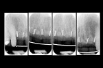 Figure 16 Radiographic control, 12-month post-extraction.