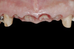 Figure 12 Edentulous ridge. Two-week post-extraction view of new sharp positive gingival architecture.