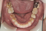 Figure 3 Mandibular arch at initial presentation with attrition, erosion, and previous restorative dentistry present.