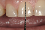Figure 6 With the patient having an 8-mm central incisor at initial presentation, the restorative dentist was comfortable prescribing a 10.5-mm central in the final prosthesis, which would add to the tooth display in repose and keep the tooth size within expected norms.