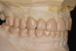 Figure 8 The completed diagnostic wax-up provided a template for the final restorations
that was used to demonstrate the clinician’s vision for the permanent restorations to the patient, fabricate the provisional restorations, and provide a guide for tooth preparation.