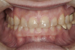 Figure 4 Retracted view of the patient in maximum intercuspation (MIP) at initial presentation; note the visible crown margins on her previous restorations and the worn and chipped edges of her maxillary incisors.
